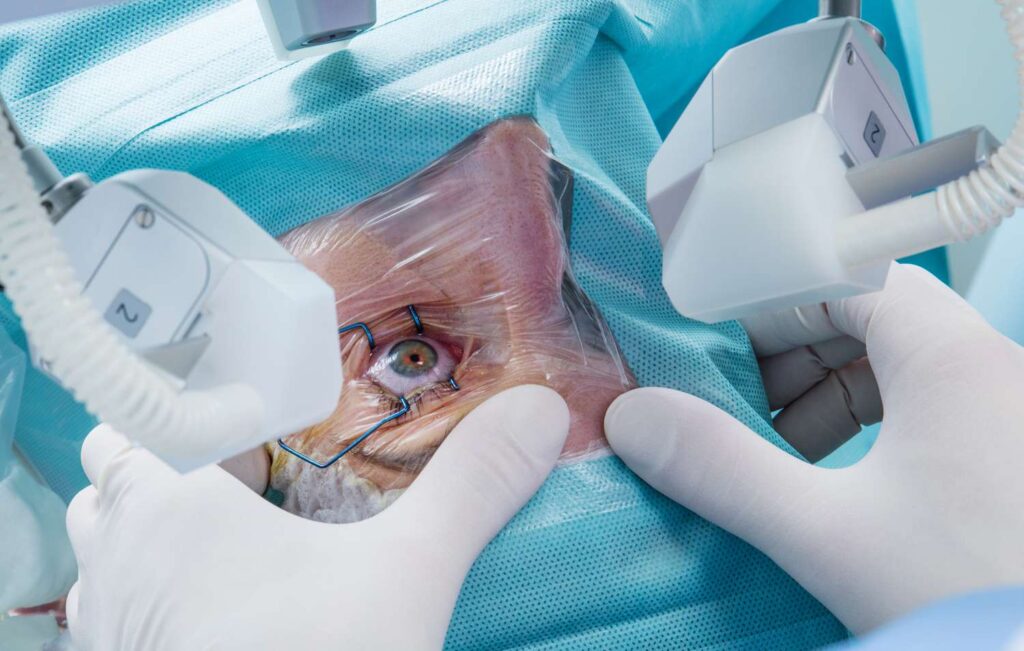 Cataract Removal